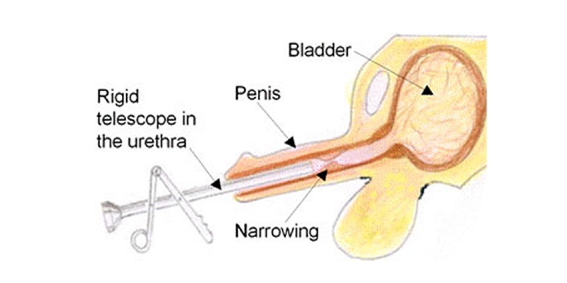 Extreme urethral fan images