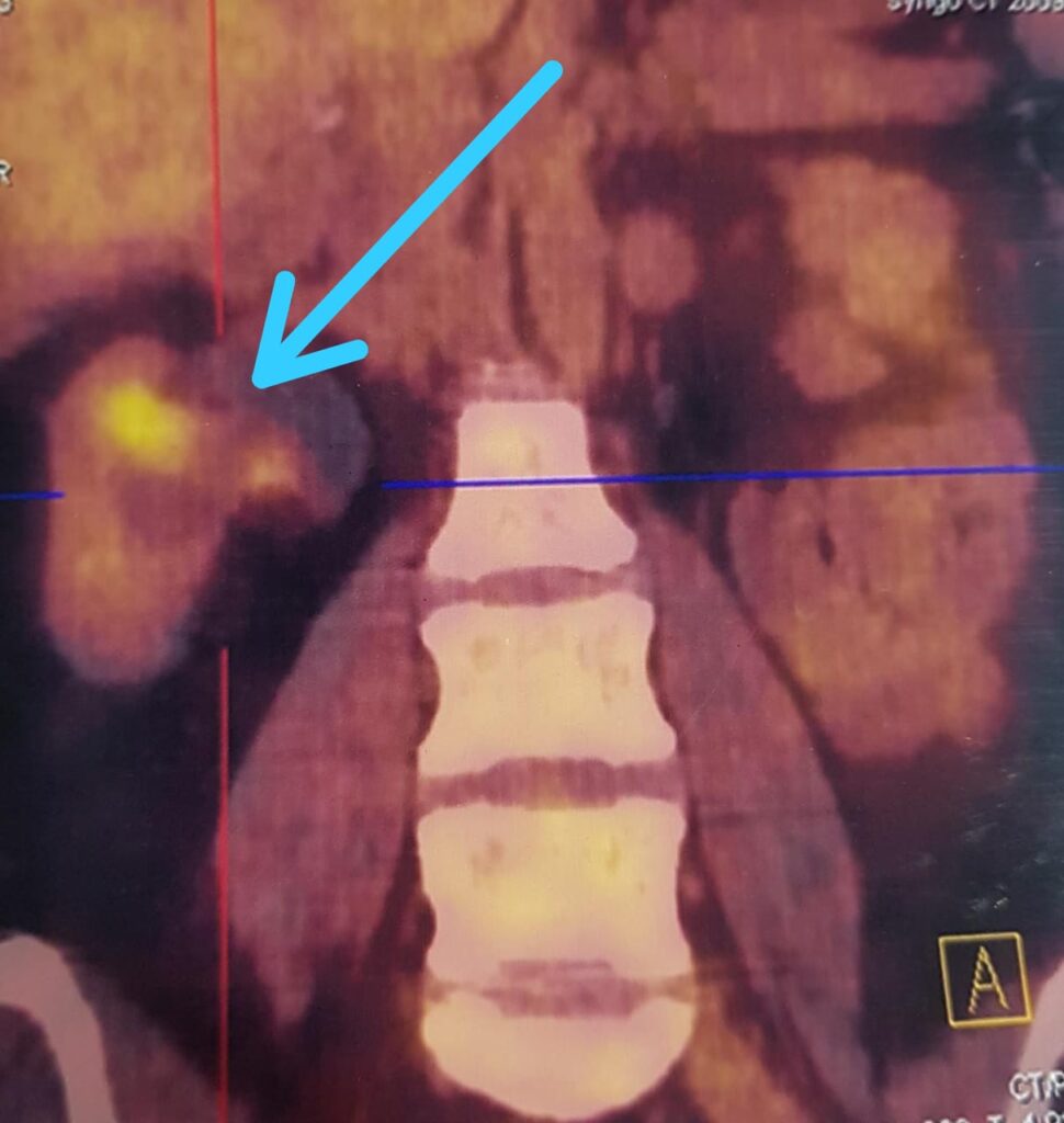 Unique Case Of 42 Year Old Omanian Female Blood in Urine Due To Kidney