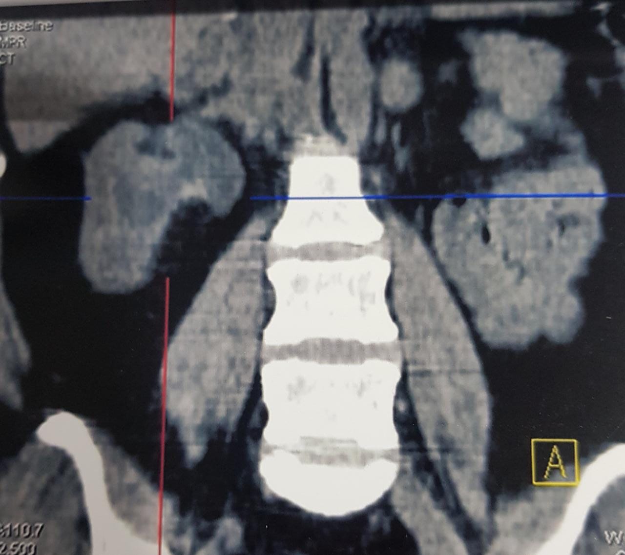 No definite mass on the ct scan as kidney was non functioning