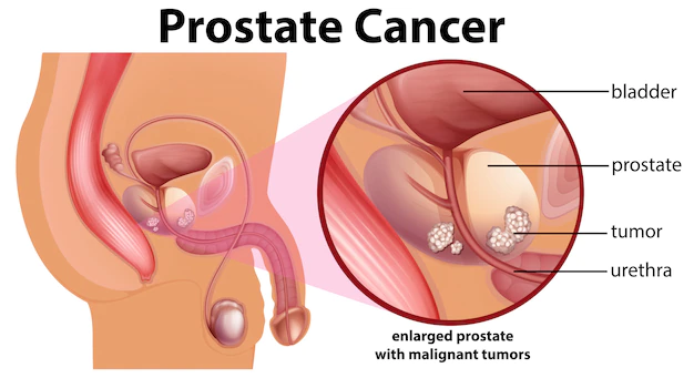 Prostate Cancer treatment in India