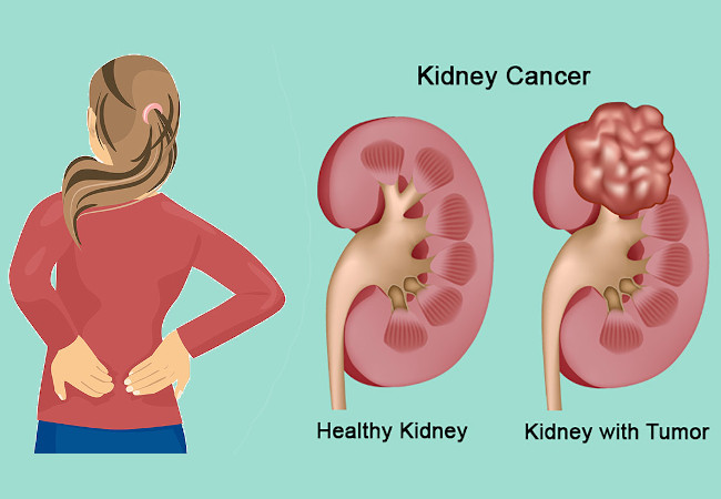 How Fast Does Kidney Cancer Spread 