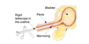 Urethral Stricture Symptoms