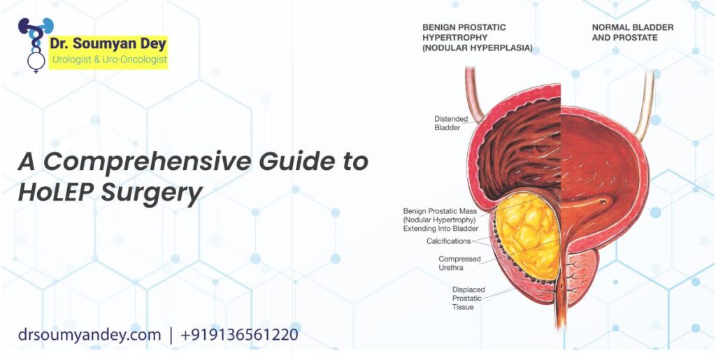 A Comprehensive Guide to HoLEP Surgery