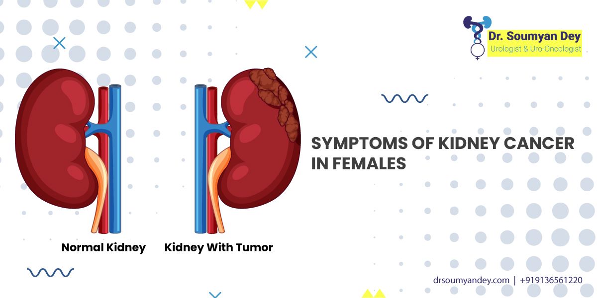 Signs and Symptoms of Kidney Cancer in Women