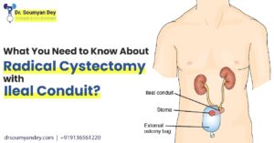What You Need to Know About Radical Cystectomy with Ileal Conduit?