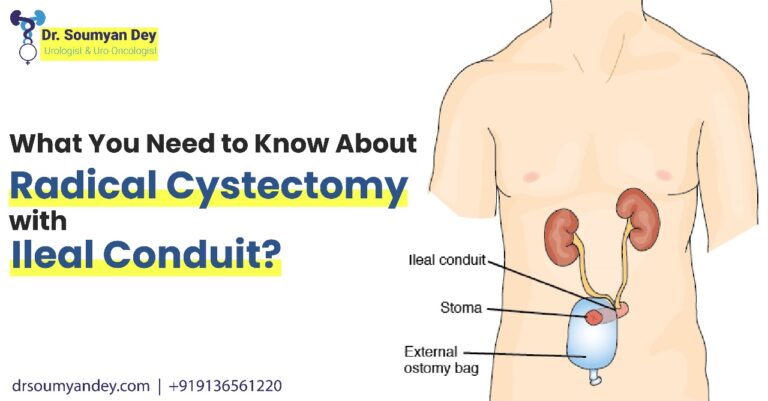 What You Need to Know About Radical Cystectomy with Ileal Conduit