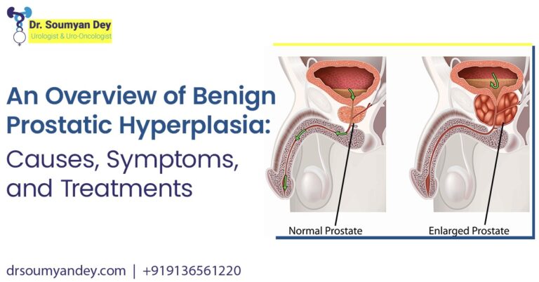An Overview of Benign Prostatic Hyperplasia