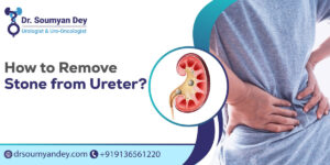 How to Remove Stone from Ureter?