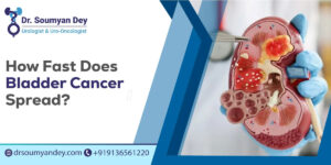 How Fast Does Bladder Cancer Spread?