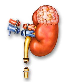 Radical Nephrectomy