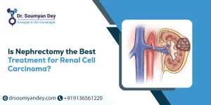 Is Nephrectomy the Best Treatment for Renal Cell Carcinoma?