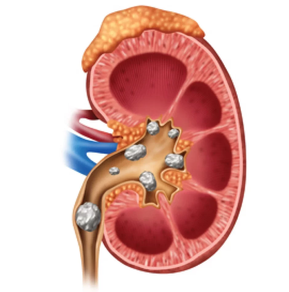Kidney stone treatment