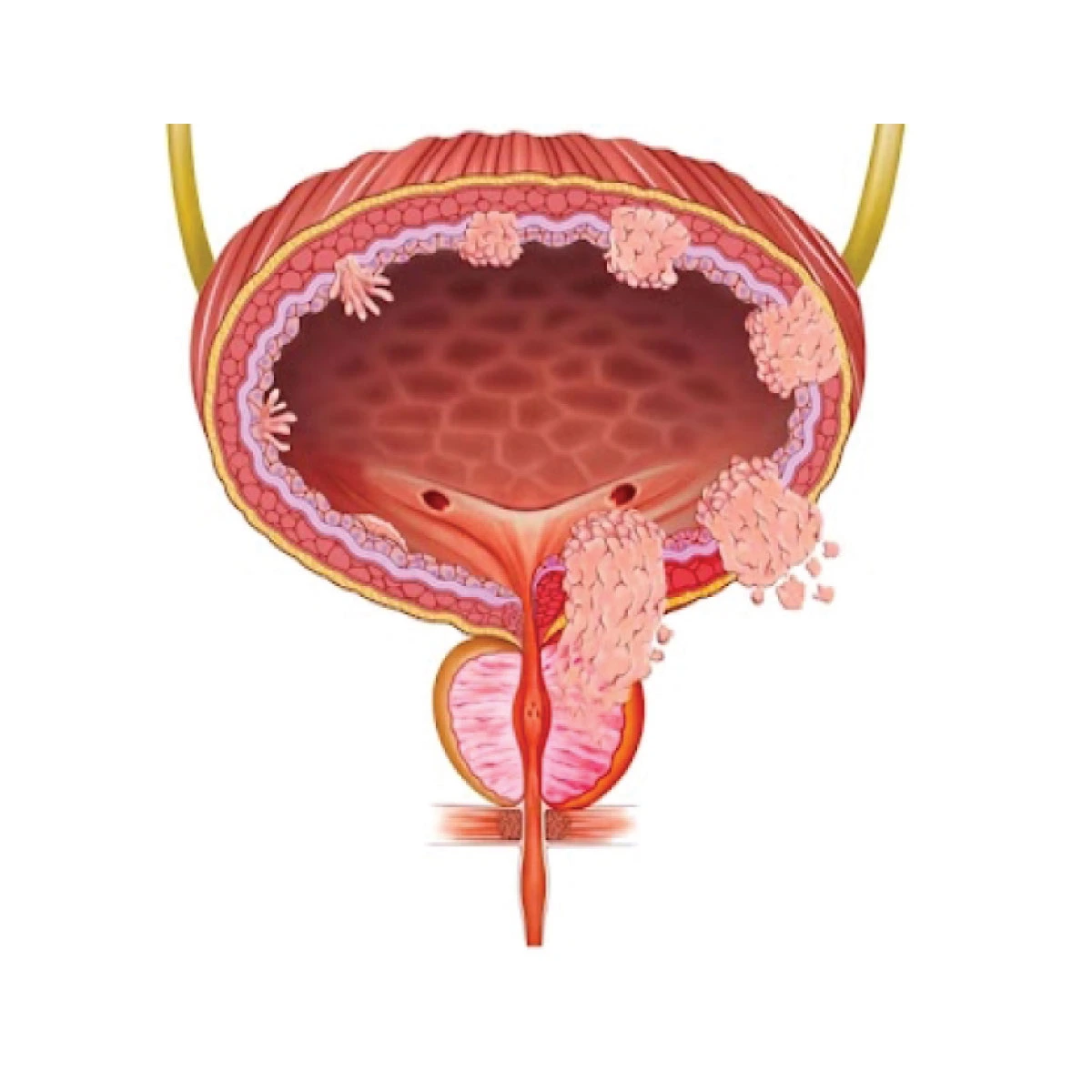 Blader cancer treatment