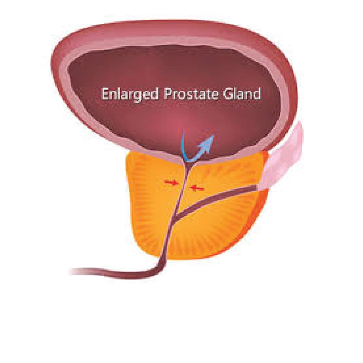 Benign prostatic hyperplasia