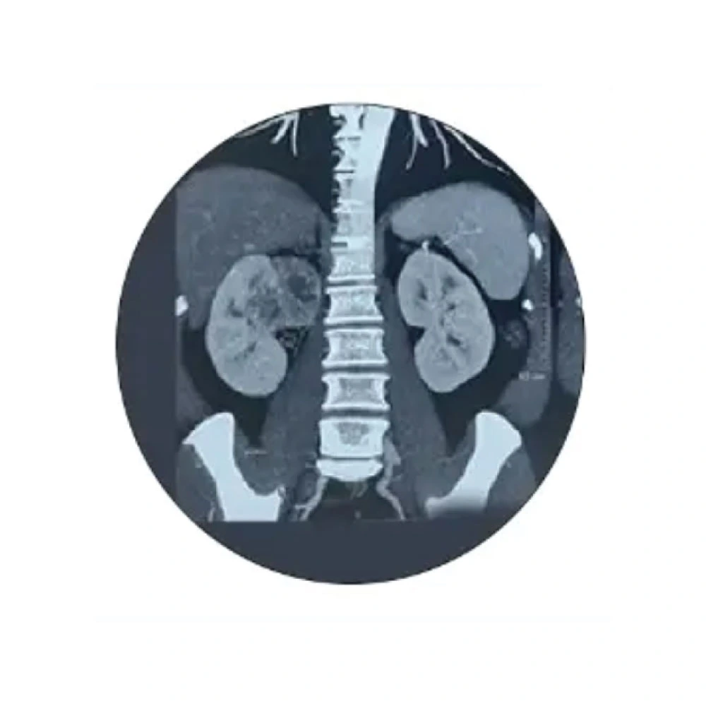 xray Kidney