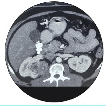 ct scan of partial nephrectomy for hilar renal tumor in young patient