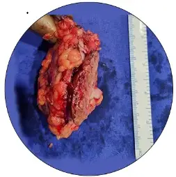 tumor removed after partial nephrectomy for hilar renal tumor in young patient