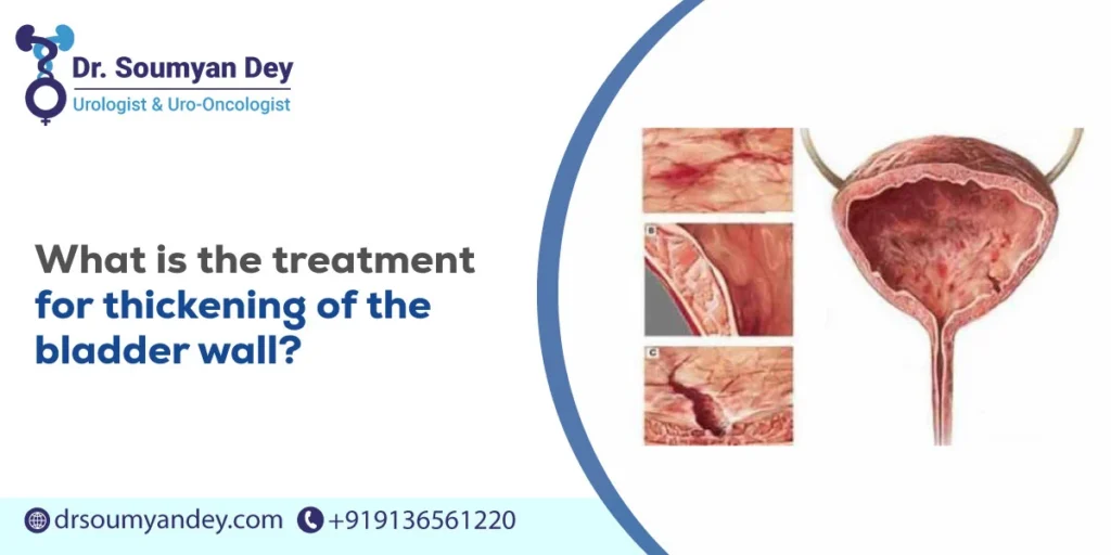 What is the Treatment for Thickening of the Bladder Wall?