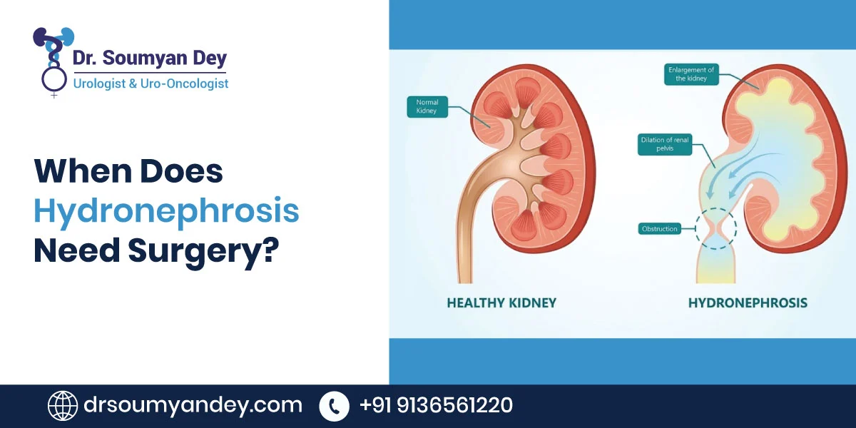 When Does Hydronephrosis Need Surgery?