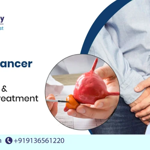 Is Prostate Cancer Curable? Stages, Survival & When to Start Treatment