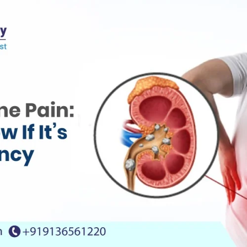 Kidney Stone Pain: How to Know If It’s an Emergency