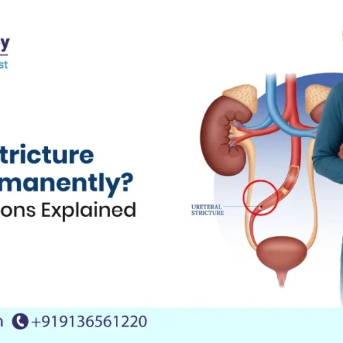 Is Urethral Stricture Curable Permanently?
