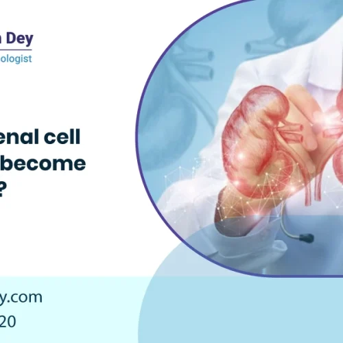 How does Renal Cell Carcinoma Become Metastatic?