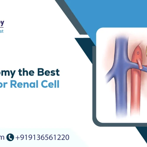 Is Nephrectomy the Best Treatment for Renal Cell Carcinoma?