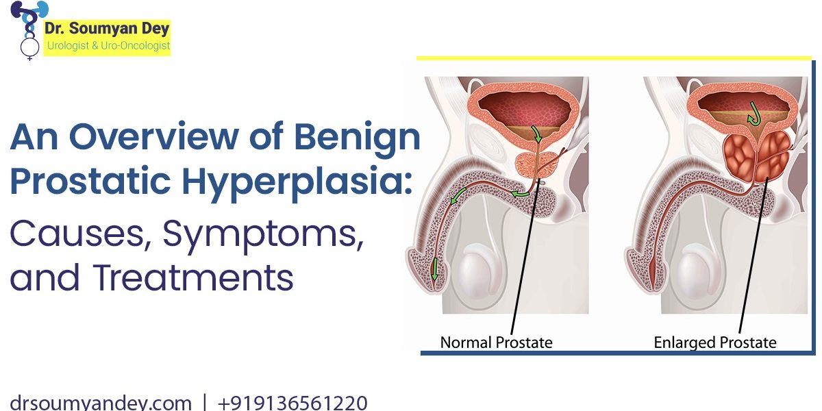 An Overview of Benign Prostatic Hyperplasia