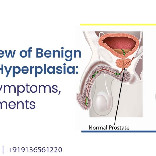 an overview of benign prostatic hyperplasia