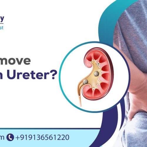 how to remove stone from ureter