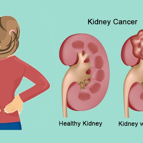 How fast does kidney cancer spread
