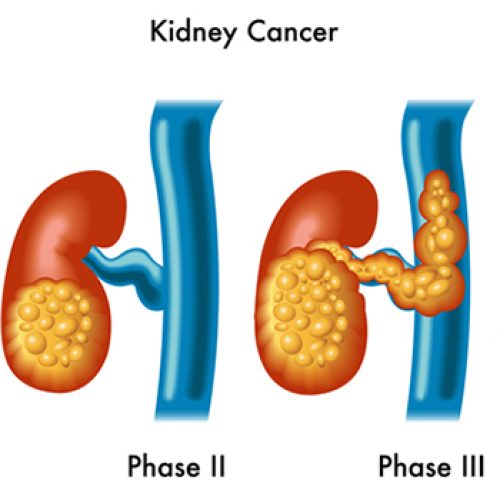 Survival Rates for Kidney Cancer