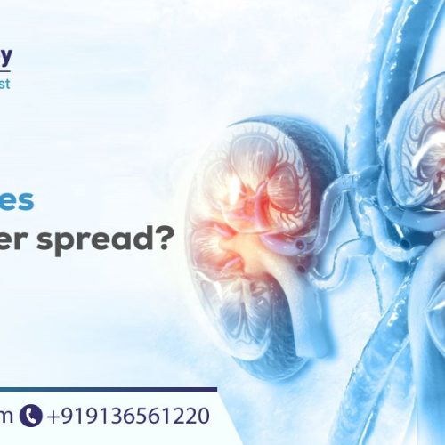 How Fast Does Kidney Cancer Spread