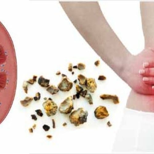 Natural Remedies for Kidney Stones