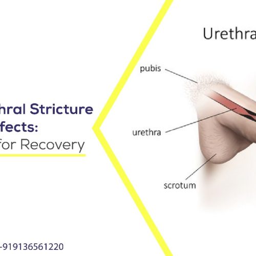 managing urethral stricture dilation side effects tips and tricks for recovery
