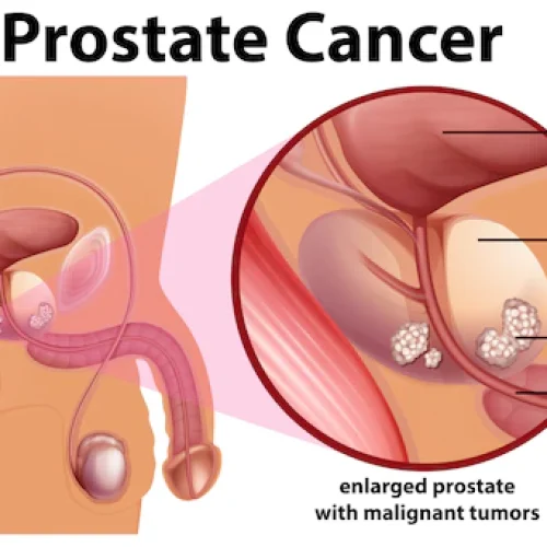 Know the Warning Signs of Prostate Cancer