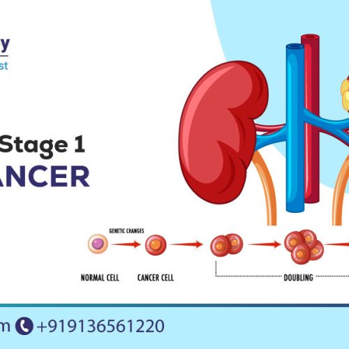 symptoms of stage 1 kidney cancer