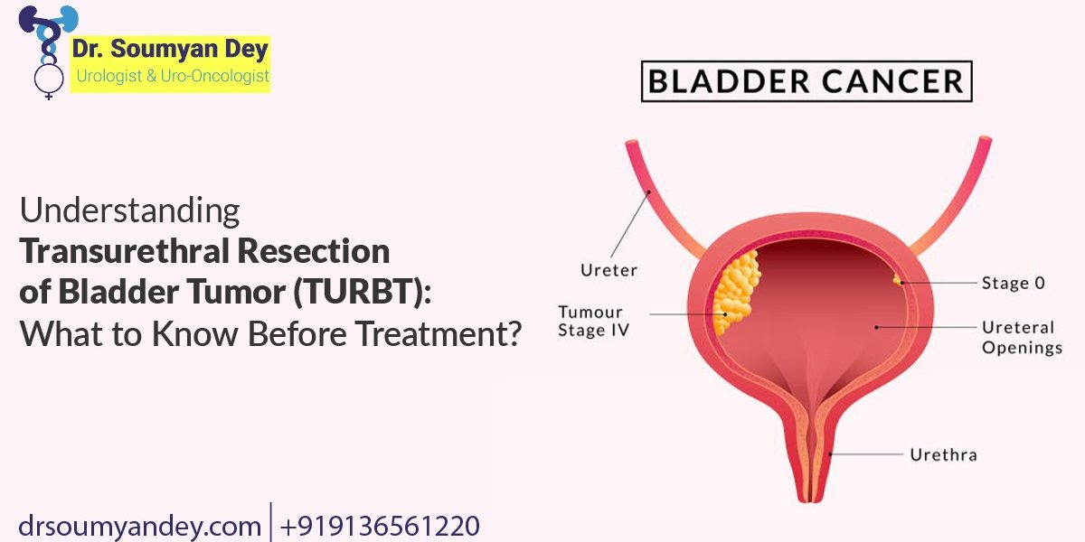 Understanding Transurethral Resection of Bladder Tumor (TURBT)_ What to Know Before Treatment