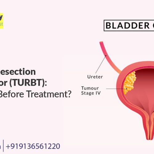 understanding transurethral resection of bladder tumor (turbt) what to know before treatment