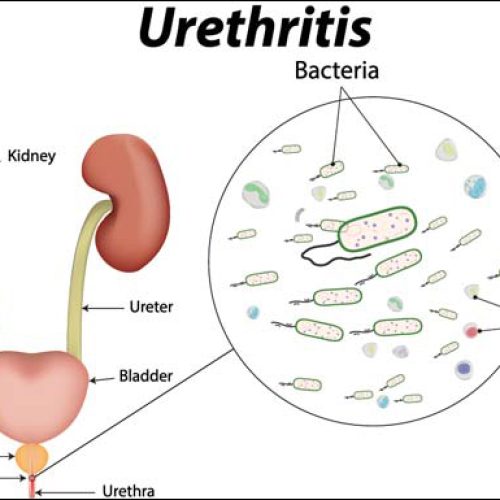 Urethritis Treatment in Mumbai