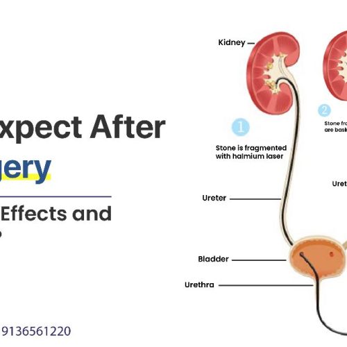 what to expect after rirs surgery common side effects and recovery tips