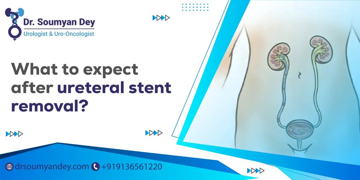 What to expect after ureteral stent removal