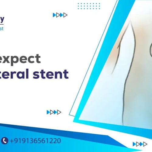 what to expect after ureteral stent removal