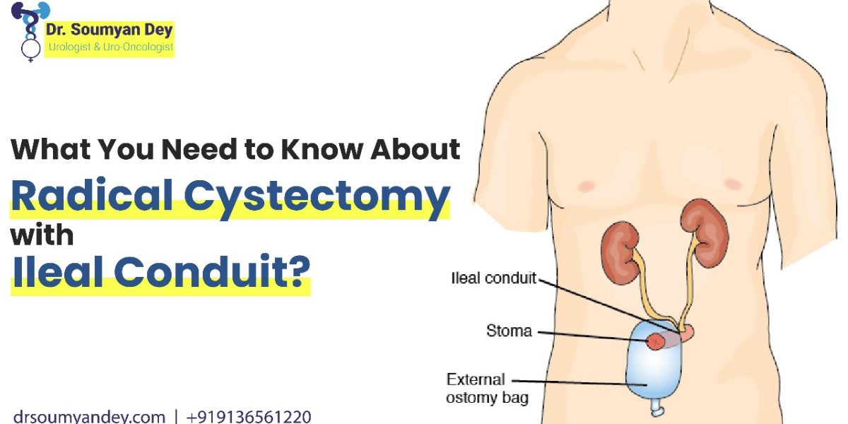 What You Need to Know About Radical Cystectomy with Ileal Conduit