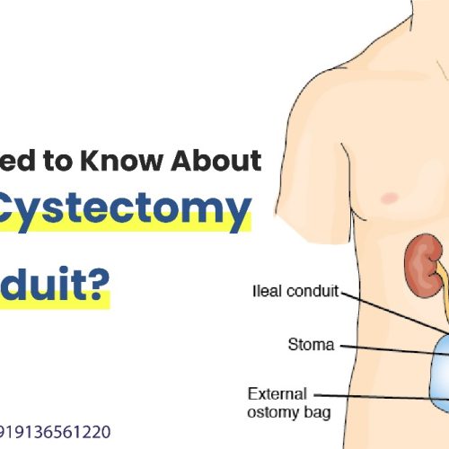 what you need to know about radical cystectomy with ileal conduit