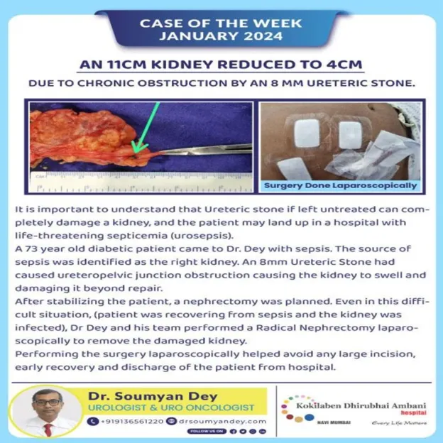 Laparoscopic radical nephrectomy performed for damaged kidney due to ureteric stone obstruction by Dr Soumyan Dey