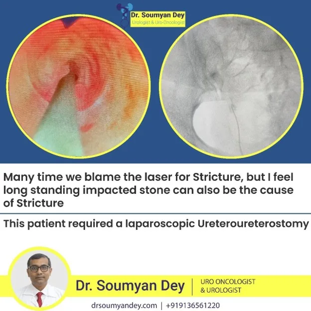 Laparoscopic ureteroureterostomy performed for ureteric stricture caused by impacted stone by Dr. Soumyan Dey