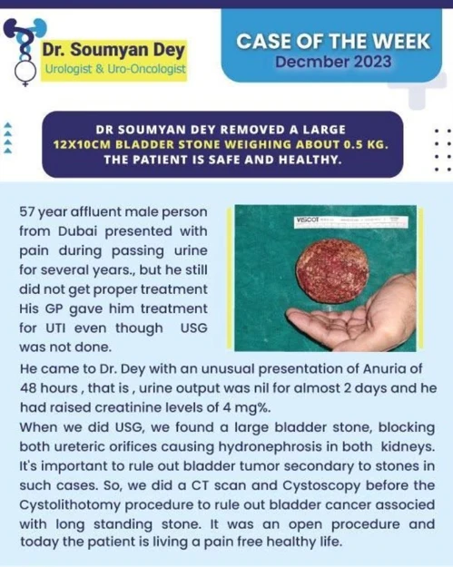 Large bladder stone removed through cystolithotomy by Dr. Soumyan Dey