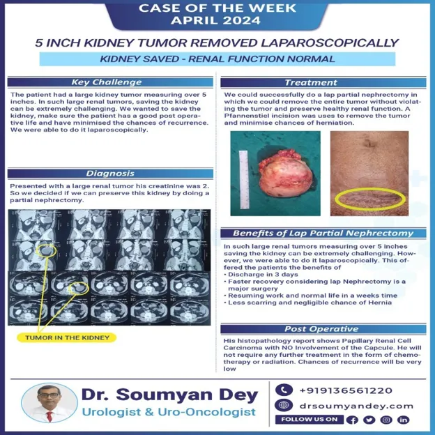 Large kidney tumor removed through laparoscopic partial nephrectomy by Dr Soumyan Dey